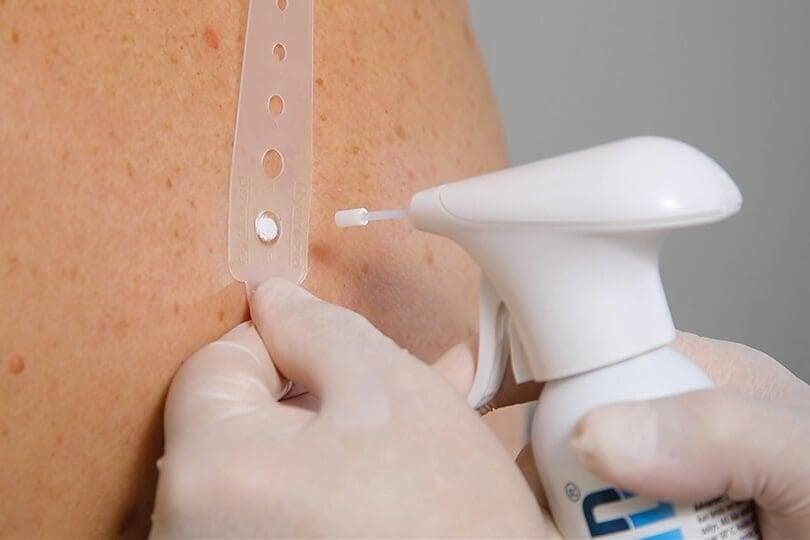 Treating Seborrheic Keratosis